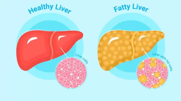 ফ্যাটি লিভারের(Fatty liver) সমস্যা দূর করার উপায়