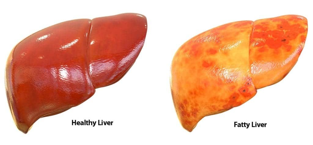 Healthy-versus-Fatty-Liver